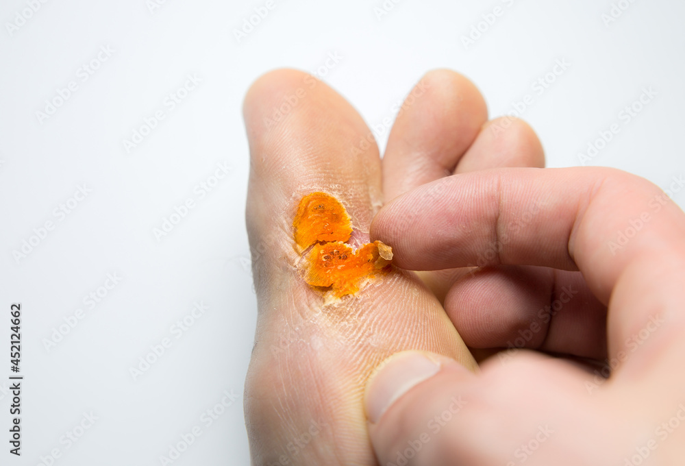 Fotografia do Stock Contagious skin illness on foot. Medical treatment photo..Close up photo of