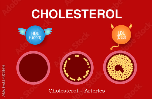 Cholesterol in artery, health risk