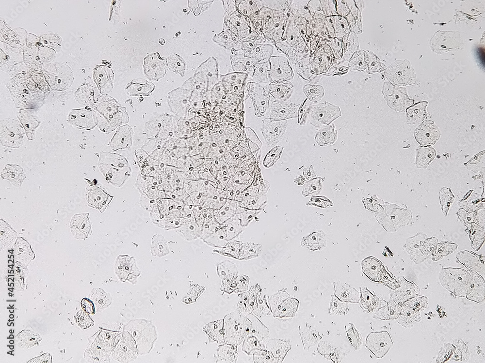 Epithelial cells with bacteria in patient urine (urinary tract