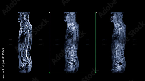 MRI of whole spine T2W , T1FS and T1FS with Gadolnilum contrast sagittal plane for diagnostic Spinal Cord Compression.