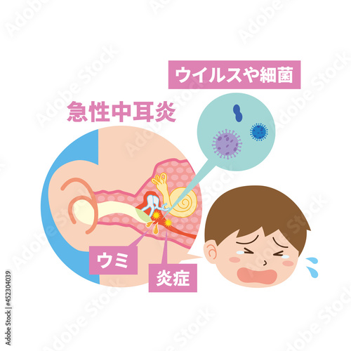 急性中耳炎で泣く男児