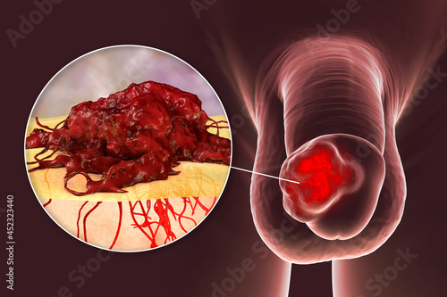 Penile cancer, 3D illustration showing malignant tumor on the human penis