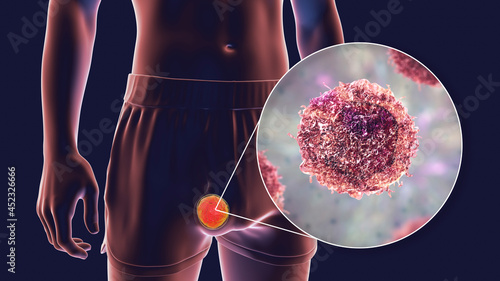 Fotografia Testicular cancer, 3D illustration
