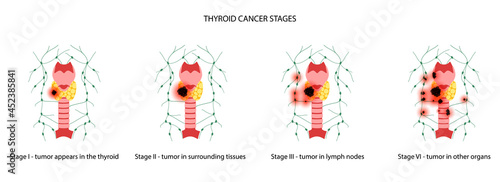 Thyroid cancer stages