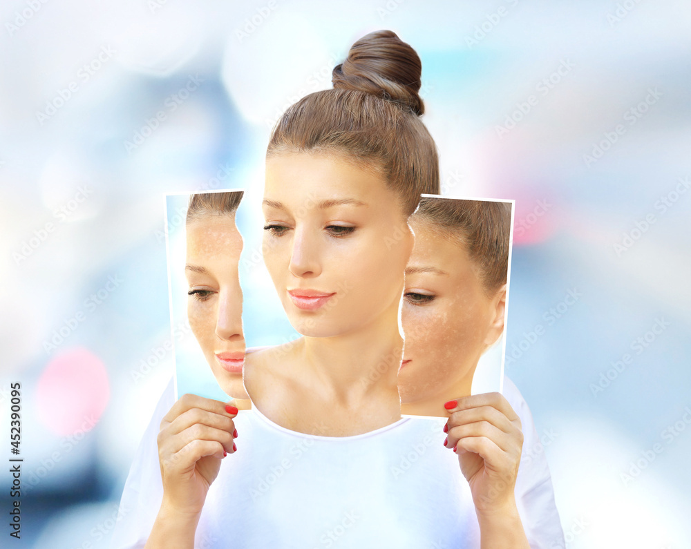 Dark spots, freckles,hyperpigmentation(melasma or chloasma),concept