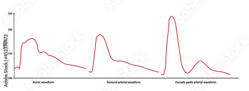 Invasive blood pressure monitoring. Aortic, femoral and dorsalis pedis waveform photo