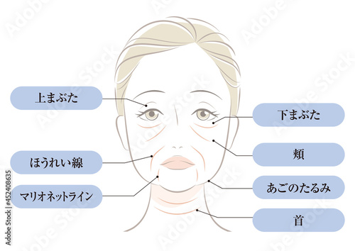 たるみの種類