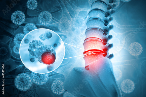 Spine cancer or spinal tumor disease.3d illustration