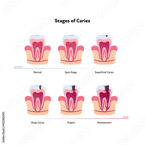 Tooth anatomy and decay chart. Vector biomedical illustration. Cross section. Stages of teeth caries isolated on white background. Design for healthcare, dentistry