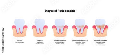 Tooth anatomy and decay chart. Vector biomedical illustration. Side view. Stages of teeth periodontitis illness isolated on white background. Design for healthcare, dentistry