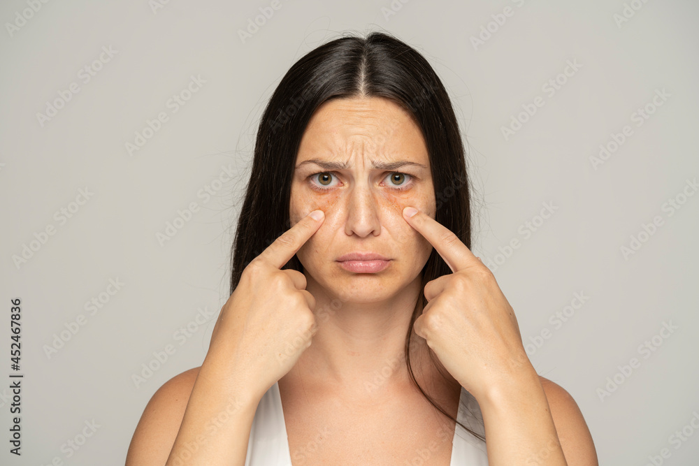 a young unhappy woman touches her undereyes a young unhappy woman touches her undereyes