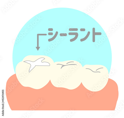 歯のシーラント