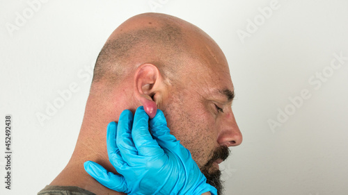 doctor with blue gloves examining an abscess with pus on a swollen and inflamed ear of a caucasian man photo