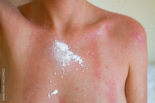 Woman with sunburn on her chest. Protective aerosol is applied to sunburn on woman s skin.
