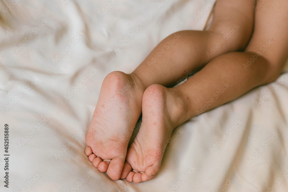 Rash of enterovirus infection picornavirus families on the feet of a 3-year-old child. Medicine, health concept. Rash of enterovirus infection picornavirus families on the feet of a 3-year-old child. Medicine, health concept.