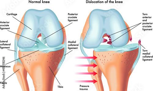 Medical illustration of symptoms of dislocated knee, with annotations.