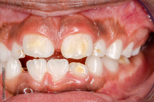 Molar incisor hypomineralization