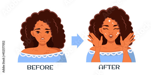 A young African-American woman with problematic skin. Before and after. Facial treatments, protection of the skin of the face and preservation of beauty. Skin care. Vector
