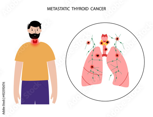 Thyroid cancer stages