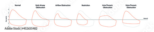 Spirometry test. Different loop of abnormal ventilatory function. 
