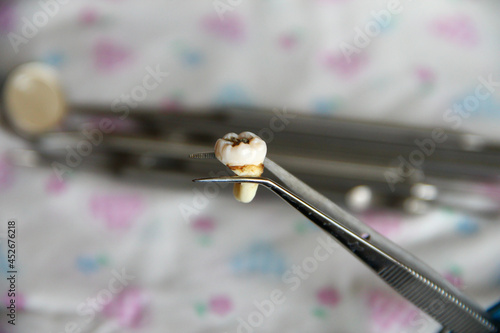 Extracted tooth in tweezers against background of dental instruments