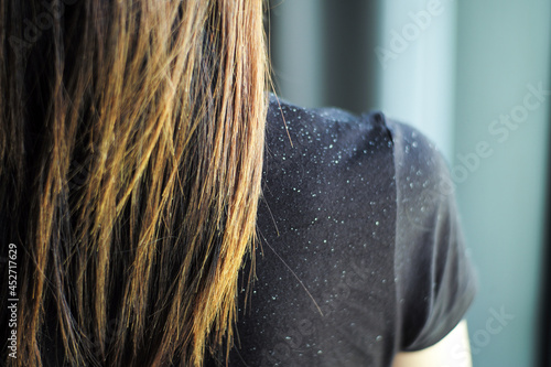 Obraz na plátně Rear view of woman having the dandruff on the shoulder