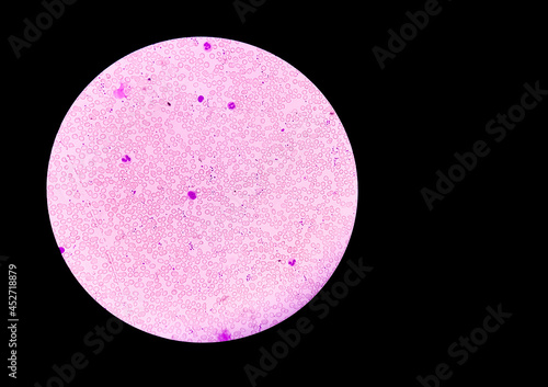 Microscopic image of Hereditary hemolytic anemia with copy space. Hemoglobin E (HbE) disease is a mild, inherited blood disorder