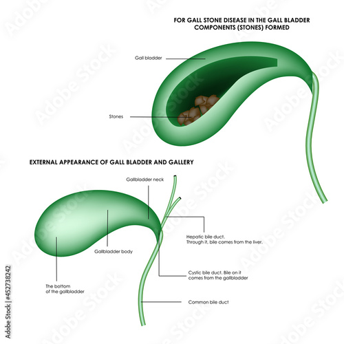 The structure of the gallbladder and stones in the gallbladder. Realistic medical illustration.