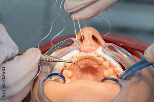 placing the fixed retainer in Process of removing dental braces from a Caucasian girl in a dental clinic with a female dentist