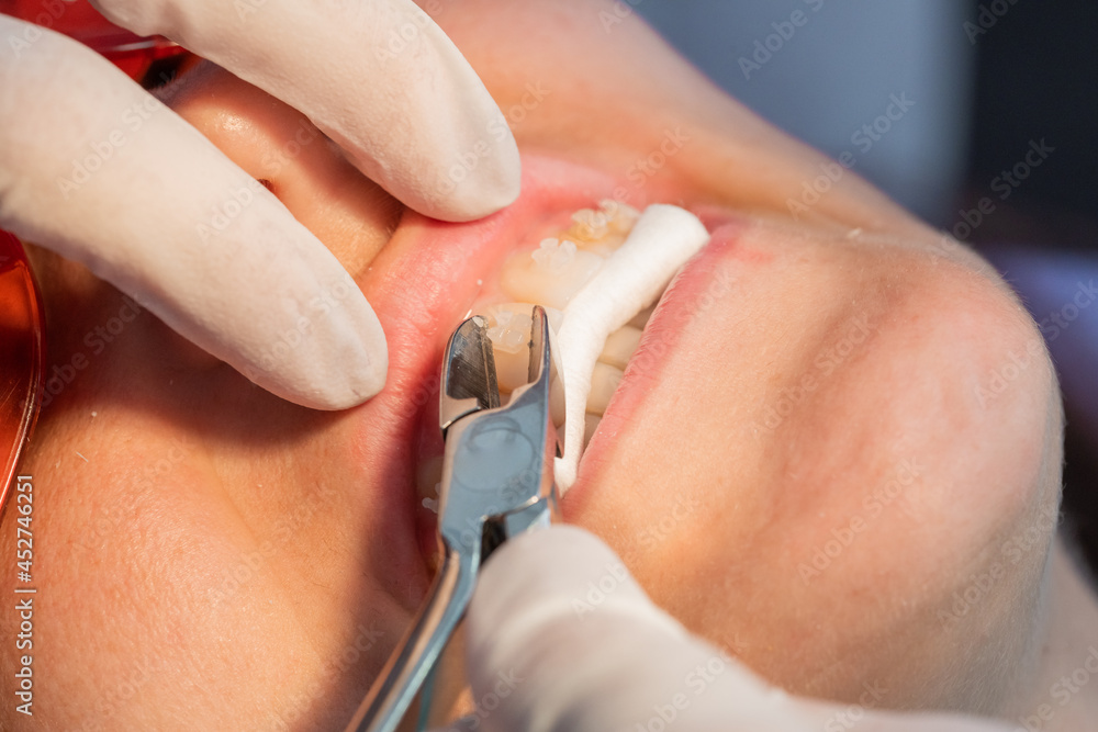 Fototapeta premium removing the brackets from the dental braces in process of removing dental braces from a Caucasian girl in a dental clinic with a female dentist