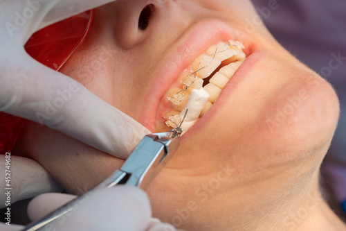 removing the brackets from the dental braces in process of removing dental braces from a Caucasian girl in a dental clinic with a female dentist