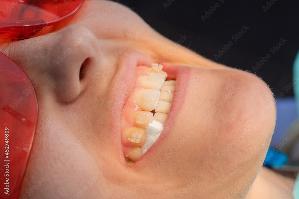 removing the brackets from the dental braces in process of removing