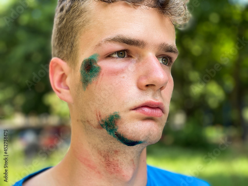 Young guy, teenager with wounds and abrasions on his face