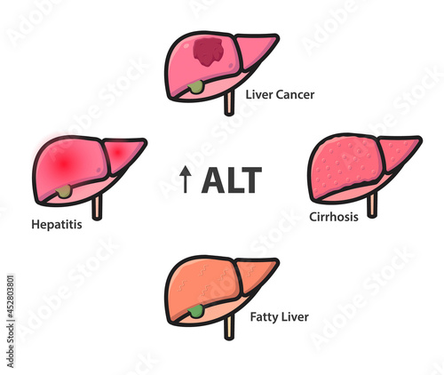 liver conditions common causes of the high level of ALT in a blood