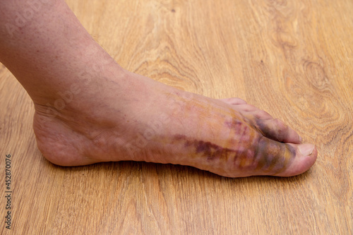 Swollen injured male limb on the left foot with hematoma when a heavy object falls on the leg photo