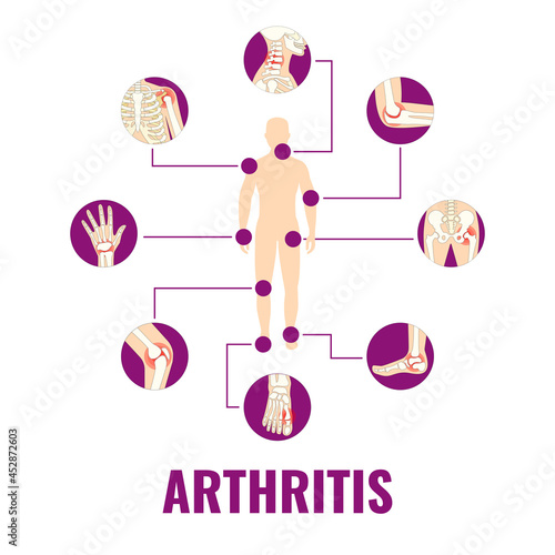 Vector Illustration of World Arthritis Day
