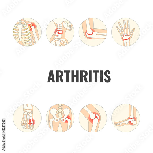 Vector Illustration of World Arthritis Day
