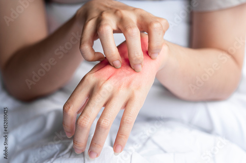 a woman was scratching her itchy hand  causing her red skin to appear due to an allergic reaction to her body or an insect bite.