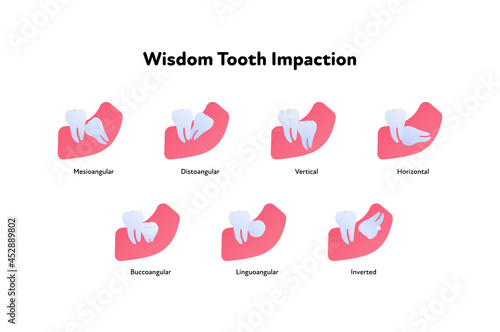 Tooth anatomy chart. Vector biomedical illustration. Cross section. Wisdom teeth impaction set isolated on white background. Design for dental oral healthcare, dentistry