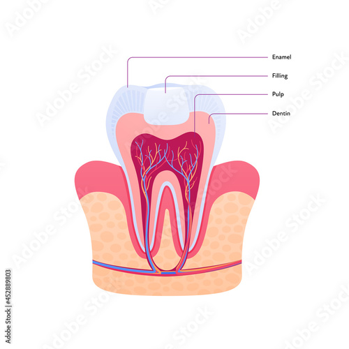 Filled tooth chart. Vector biomedical illustration. Cross section. Teeth with filling in gum isolated on white background. Design for dental oral healthcare, dentistry