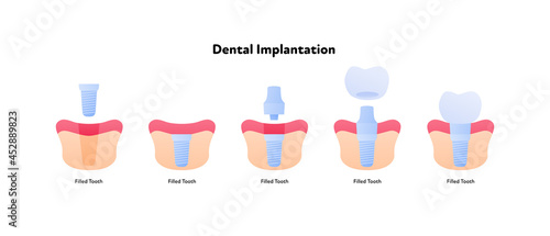Tooth implant chart. Vector biomedical illustration. Cross section. Teeth prosthesis implantation steps isolated on white background. Design for dental oral healthcare, dentistry