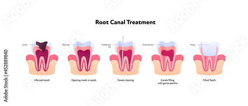 Tooth decay and root canal treatment chart. Vector biomedical illustration. Cross section. Teeth in gum feeling steps isolated on white background. Design for dental oral healthcare, dentistry photo