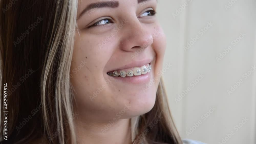 Beautiful caucasian young girl with green eyes looks at camera and sincerely laughs. Brunette teen girl in dental braces nickers. Teenage concept. Tooth alignment with braces. Cheerful young woman. Beautiful caucasian young girl with green eyes looks at camera and sincerely laughs. Brunette teen girl in dental braces nickers. Teenage concept. Tooth alignment with braces. Cheerful young woman.