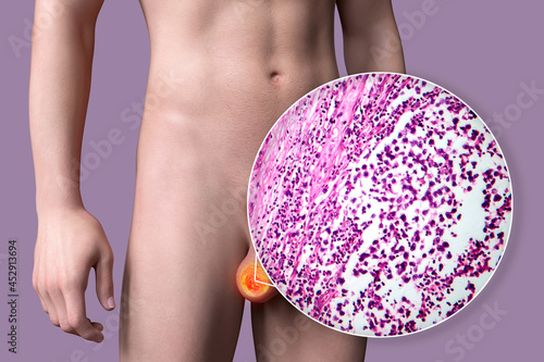 Testicular cancer, testicular seminoma, medical 3D illustration and light micrograph photo