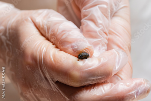 Traditional alternative medicine - doctor doing procedure of hirudotherapy for young woman. photo