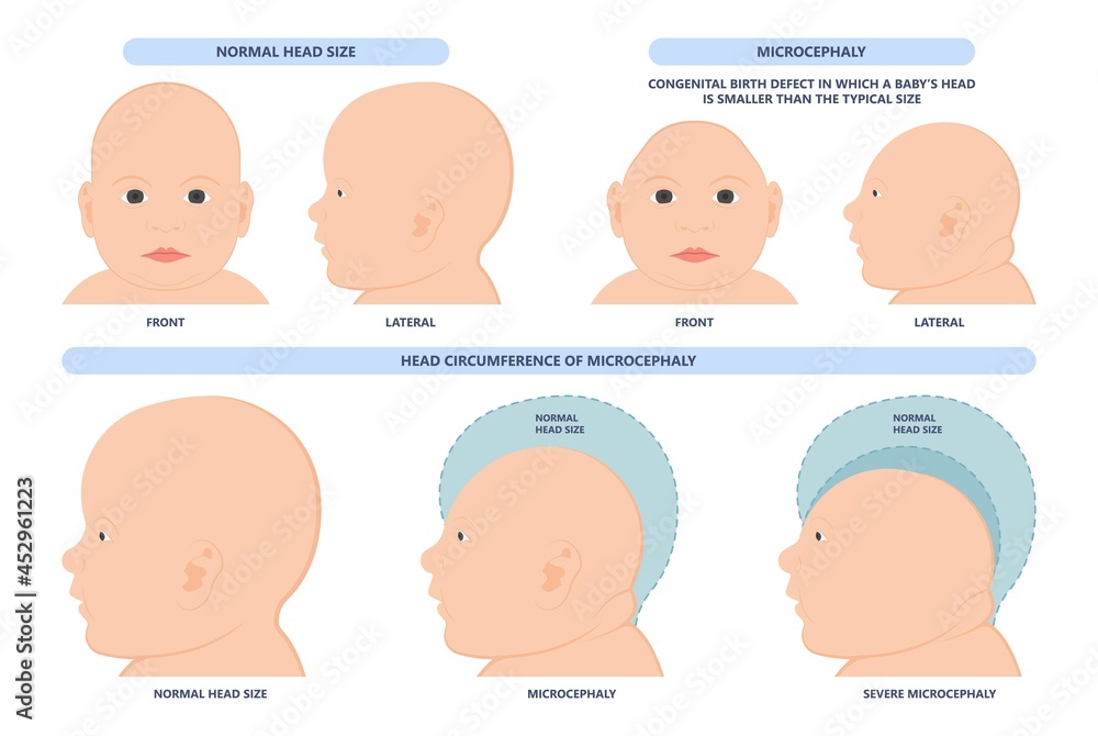 small head zika virus down autism birth defect baby brain infant fetus