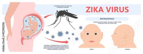 small head zika virus down autism birth defect baby brain infant fetus major severe speech Born gene toxic test genetic disease mutation DNA measure size fetal anoxia drug flat risk