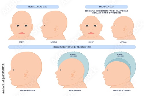 small head zika virus down autism birth defect baby brain infant fetus major severe speech Born gene toxic test genetic disease mutation DNA measure size fetal anoxia drug flat risk