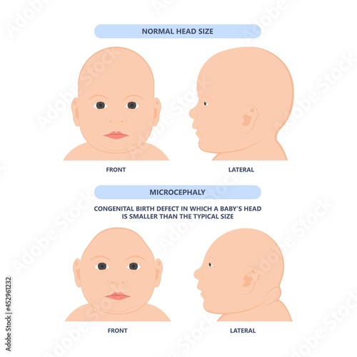 small head zika virus down autism birth defect baby brain infant fetus major severe speech Born gene toxic test genetic disease mutation DNA measure size fetal anoxia drug flat risk