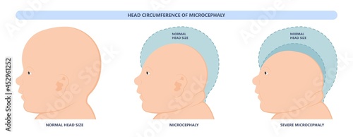 small head zika virus down autism birth defect baby brain infant fetus major severe speech Born gene toxic test genetic disease mutation DNA measure size fetal anoxia drug flat risk photo